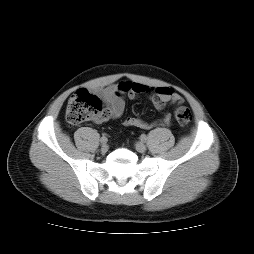 File:Obstructing ureteric calculus (Radiopaedia 18615-18514 Axial non-contrast 41).jpg