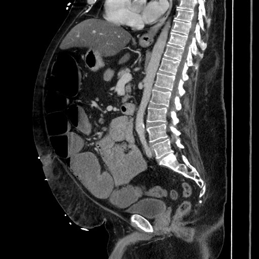 Obstructive colonic diverticular stricture (Radiopaedia 81085-94675 C 128).jpg