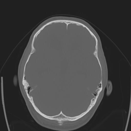 File:Obstructive hydrocephalus (Radiopaedia 30453-31119 Axial bone window 21).jpg