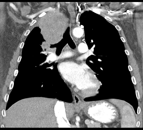 File:Obstructive superior vena cava tumor thrombus (Radiopaedia 28046-28306 B 25).jpg