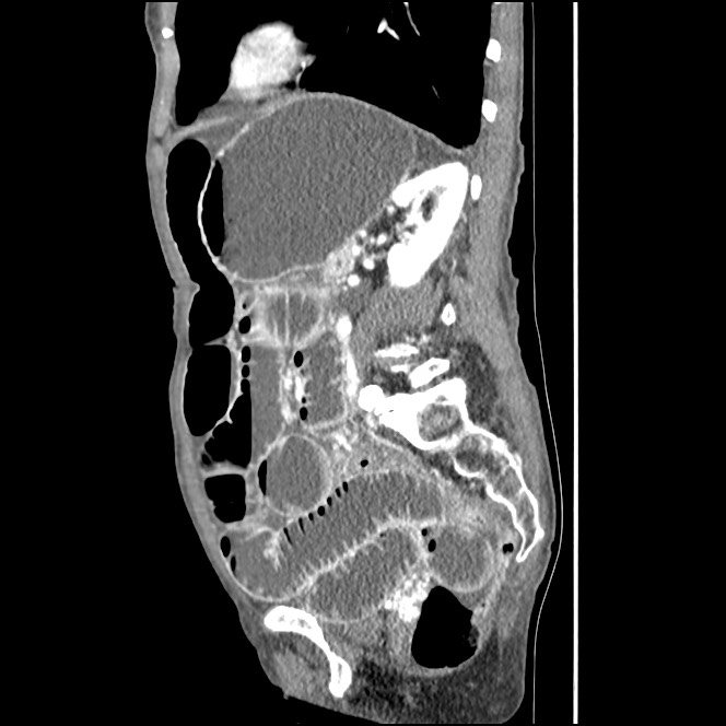 Obturator hernia causing small bowel obstruction (Radiopaedia 65522-74612 C 35).jpg