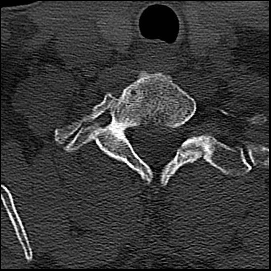 Occipital condyle fracture (type 1) (Radiopaedia 87670-104084 Axial bone window 77).jpg