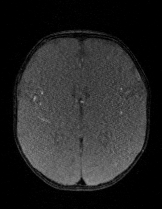 Occipital horn syndrome (Radiopaedia 14255-14129 MRA 88).jpg