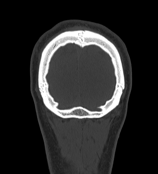 Occipital spur and Currarino type A atlas anomaly (Radiopaedia 87027-103285 Coronal bone window 131).jpg