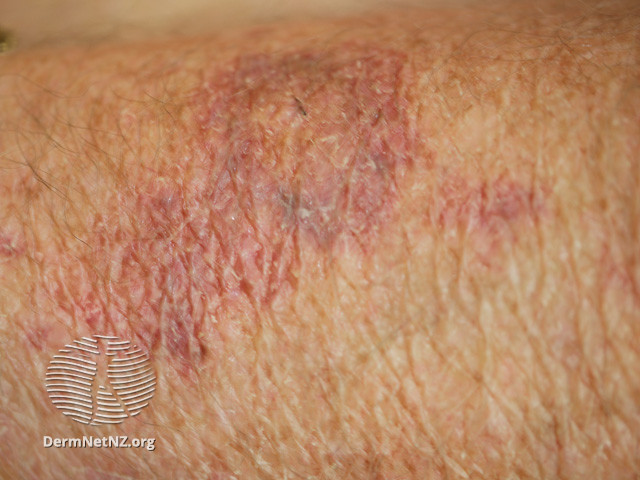 File:Senile purpura (DermNet NZ vascular-senile-purpura-2).jpg