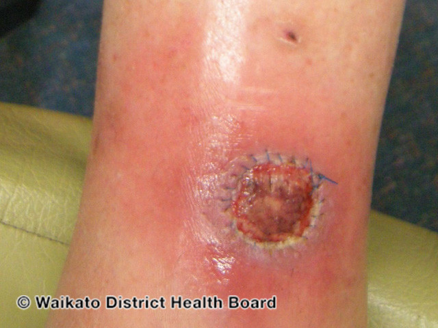 File:Wound infection (DermNet NZ reactions-w-infection01).jpg