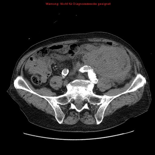 File:Abdominal aortic aneurysm- extremely large, ruptured (Radiopaedia 19882-19921 Axial C+ arterial phase 54).jpg