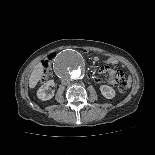 File:Abdominal aortic aneurysm (Radiopaedia 13341-13340 Axial C+ arterial phase 103).jpg