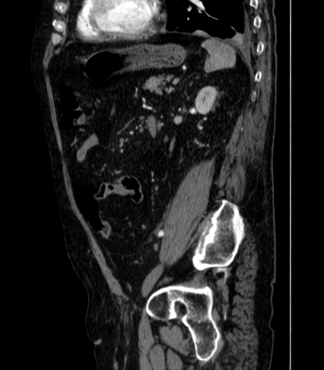 Abdominal aortic aneurysm (Radiopaedia 25855-26001 Sagittal C+ arterial phase 49).jpg
