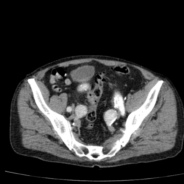 Abdominal aortic aneurysm (Radiopaedia 29248-29660 Axial C+ arterial phase 72).jpg