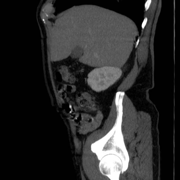 Abdominal aortic aneurysm (Radiopaedia 29248-29660 Sagittal C+ arterial phase 11).jpg