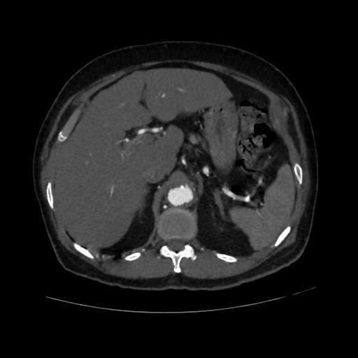 File:Abdominal aortic aneurysm (Radiopaedia 57318-64259 Axial C+ arterial phase 18).jpg