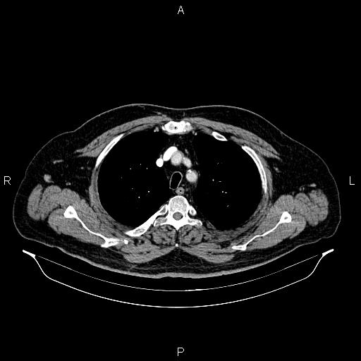 Abdominal aortic aneurysm (Radiopaedia 83094-97462 Axial renal cortical phase 19).jpg