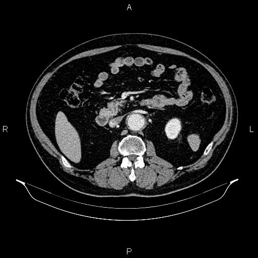 Abdominal aortic aneurysm (Radiopaedia 83094-97462 Axial renal cortical phase 91).jpg