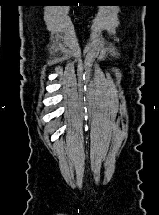 Abdominal aortic aneurysm (Radiopaedia 83094-97462 Coronal renal cortical phase 87).jpg