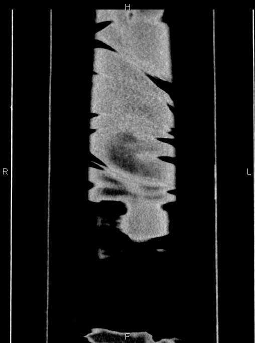 Abdominal aortic aneurysm (Radiopaedia 83094-97462 Coronal renal cortical phase 97).jpg