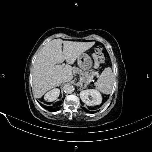 Abdominal aortic aneurysm (Radiopaedia 85063-100606 Axial C+ delayed 13).jpg