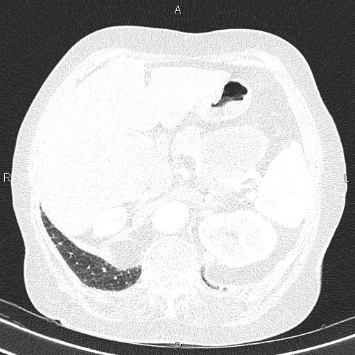 Abdominal aortic aneurysm (Radiopaedia 85063-100606 Axial lung window 62).jpg