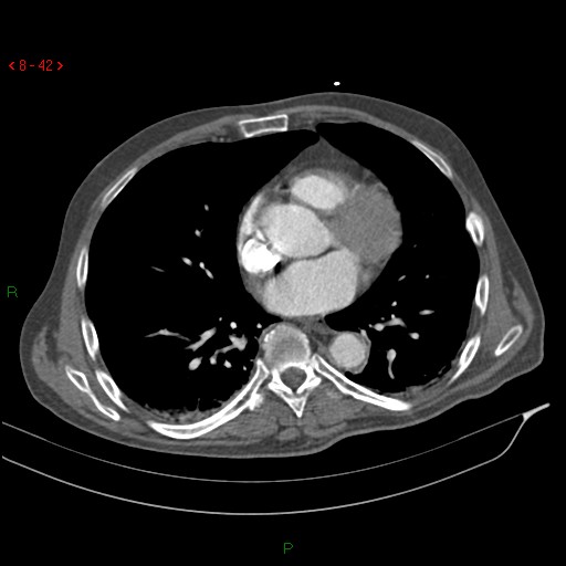 Abdominal aortic aneurysm rupture with aortocaval fistula (Radiopaedia 14897-14841 Axial C+ arterial phase 42).jpg