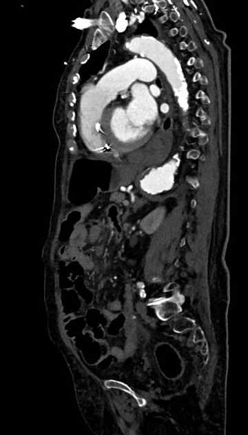 Abdominal aortic aneurysm with thrombus fissuration (Radiopaedia 73192-83919 Sagittal C+ arterial phase 53).jpg