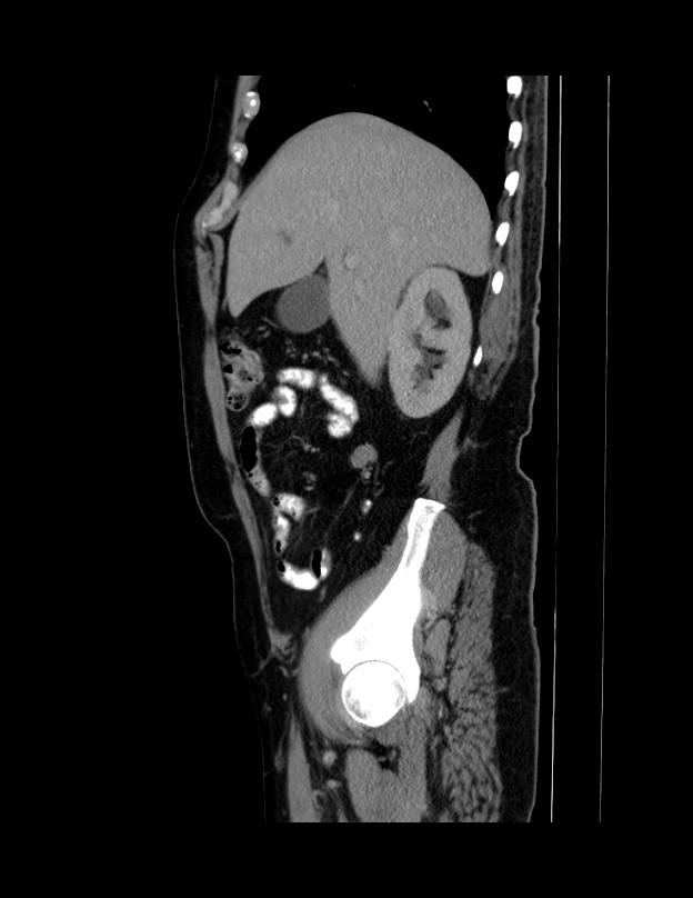 Abdominal lymphoma - with sandwich sign (Radiopaedia 53486-59492 Sagittal C+ portal venous phase 59).jpg