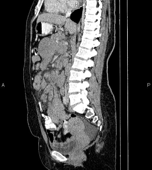 Abdominal lymphoma with sandwich sign (Radiopaedia 84378-99704 Sagittal C+ portal venous phase 43).jpg