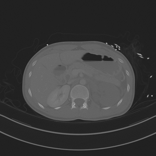 Abdominal multi-trauma - devascularised kidney and liver, spleen and pancreatic lacerations (Radiopaedia 34984-36486 Axial bone window 26).png