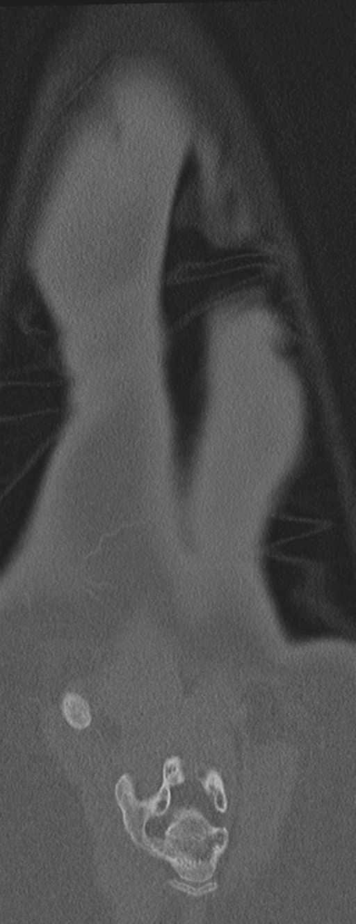 Abdominal multi-trauma - devascularised kidney and liver, spleen and pancreatic lacerations (Radiopaedia 34984-36486 Coronal bone window 71).png