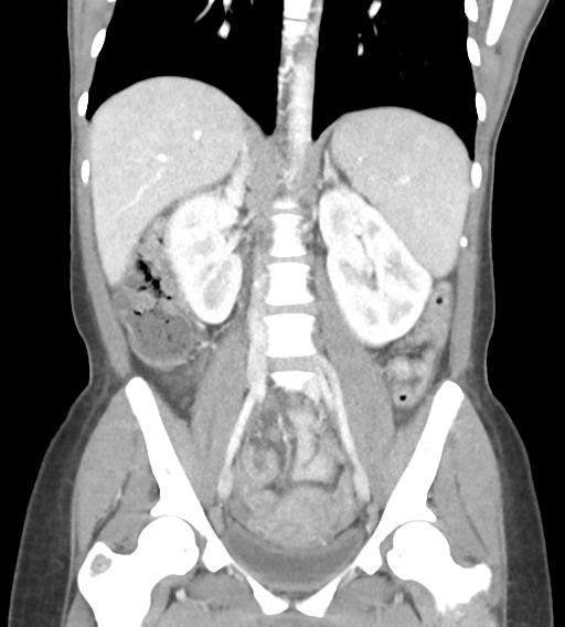 File:Abdominal tuberculosis and appendicitis (Radiopaedia 65631-74735 Coronal C+ portal venous phase 29).png