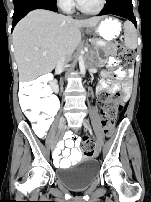 Abdominal wall and retroperitoneal tuberculosis (Radiopaedia 88137-104729 Coronal C+ portal venous phase 51).jpg