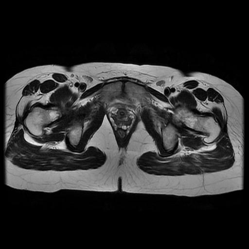 File:Abdominal wall endometriosis (Radiopaedia 83702-98847 Axial T2 17).jpg