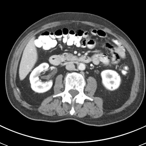 Abdominal wall metastasis from colorectal carcinoma (Radiopaedia 31016-31717 Axial C+ portal venous phase 35).jpg
