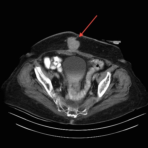 File:Abdominal wall recurrence after colorectal resection for cancer (Radiopaedia 23444-23524 A 1).jpg