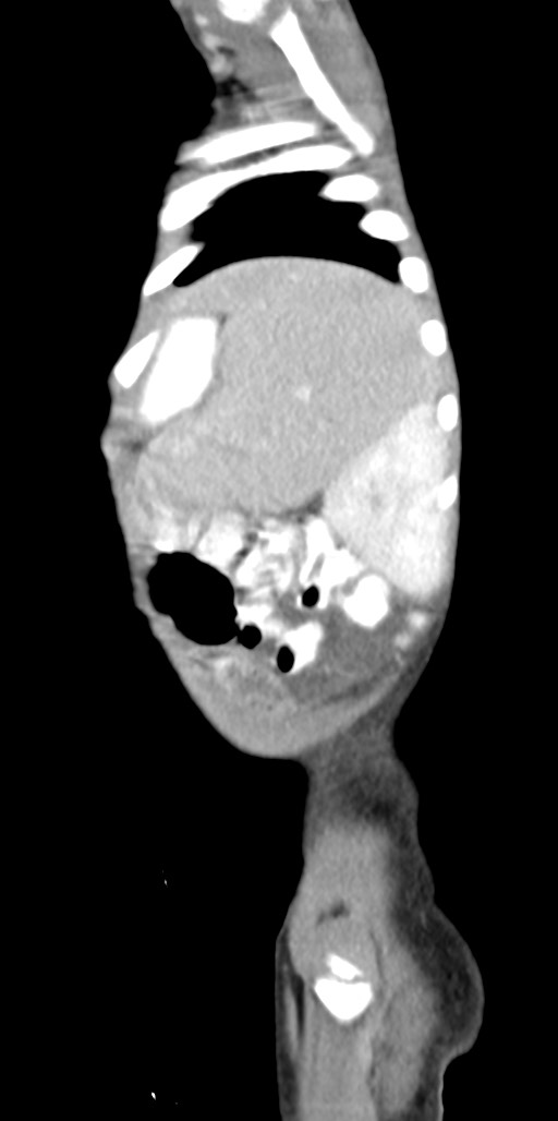 Abdominopelvic rhabdomyosarcoma (Radiopaedia 78356-90984 Sagittal C+ portal venous phase 15).jpg