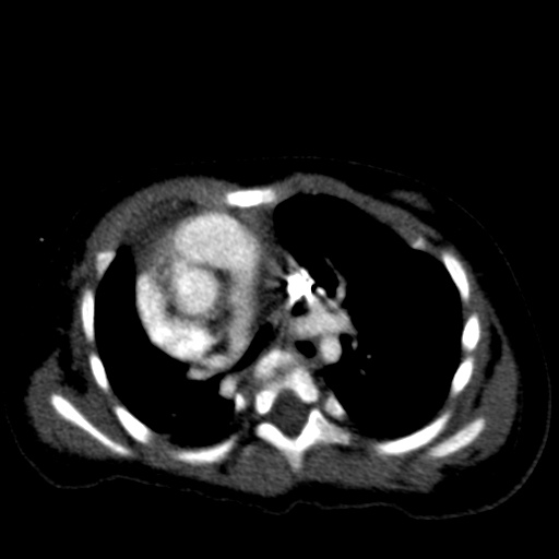 Aberrant left pulmonary artery (pulmonary sling) (Radiopaedia 42323-45435 Axial C+ CTPA 21).jpg