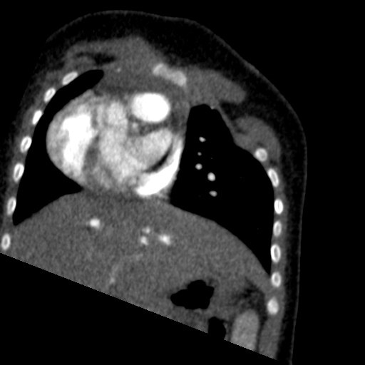File:Aberrant left pulmonary artery (pulmonary sling) (Radiopaedia 42323-45435 Coronal C+ CTPA 18).jpg