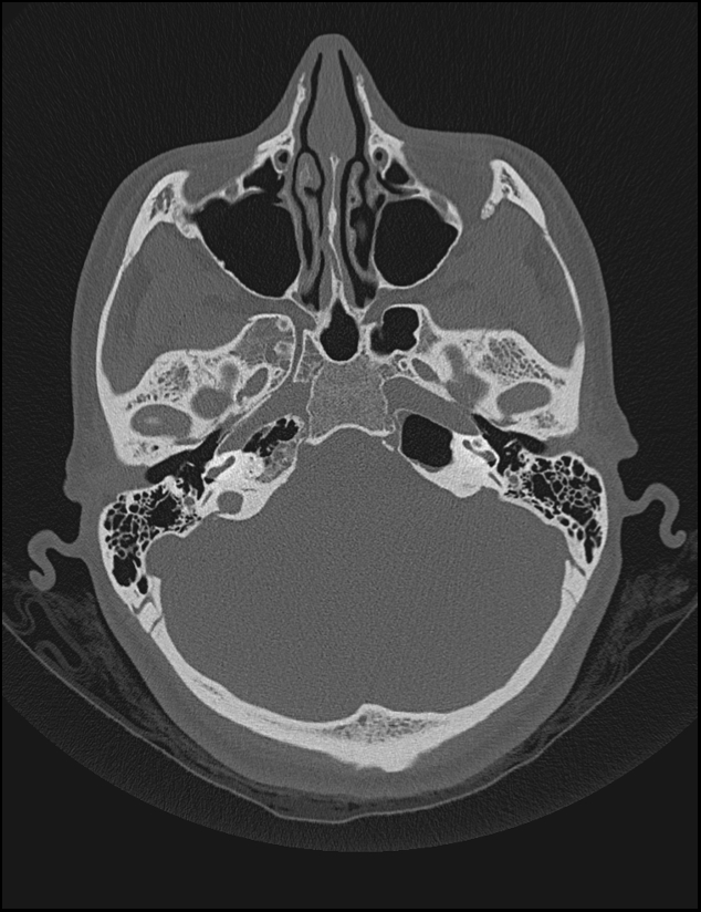 Aberrant right internal carotid artery (Radiopaedia 65191-74198 Axial non-contrast 40).jpg