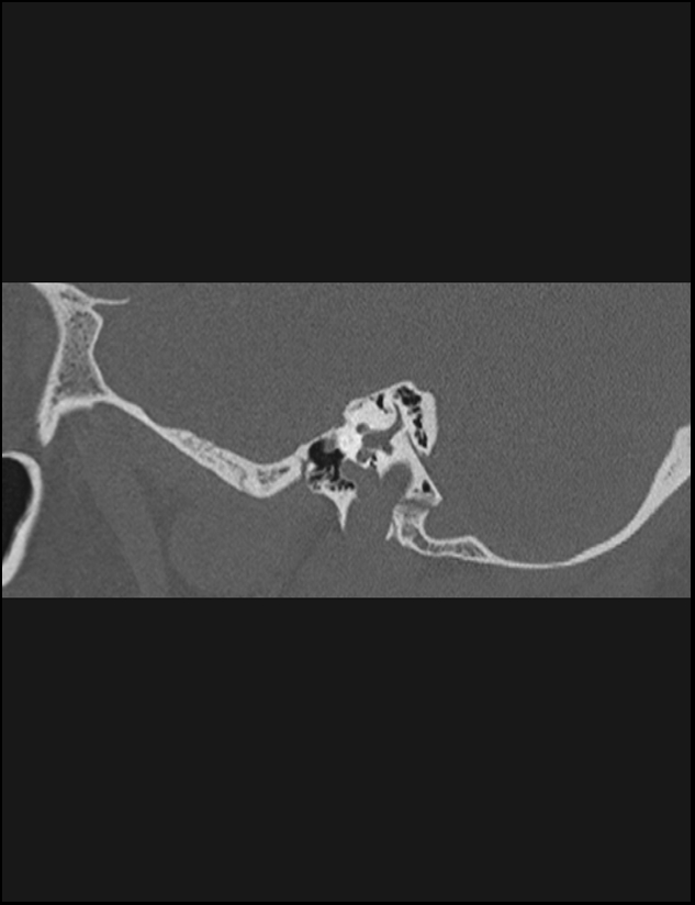 Aberrant right internal carotid artery (Radiopaedia 65191-74198 Sagittal non-contrast 52).jpg