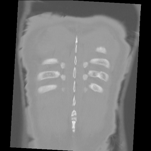 Aberrant right subclavian artery (arteria lusoria) (Radiopaedia 66584-75879 Coronal C+ arterial phase 59).png