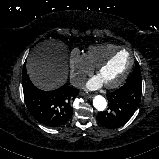 Aberrant right subclavian artery with Kommerell diverticulum (Radiopaedia 47982-52769 Axial C+ arterial phase 69).png