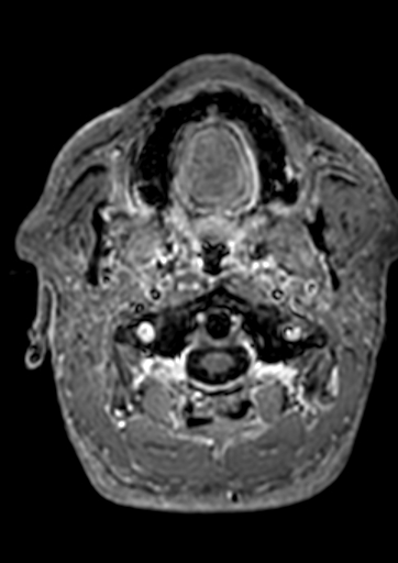 Accessory middle cerebral artery (Radiopaedia 73114-83828 Axial T1 C+ 214).jpg