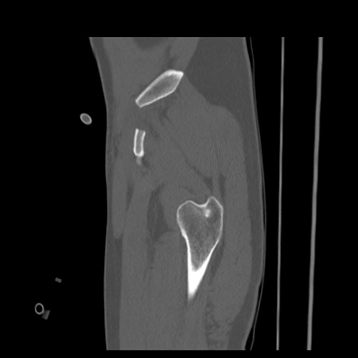 Acetabular and ilial fractures (Radiopaedia 59084-66378 Sagittal bone window 11).jpg
