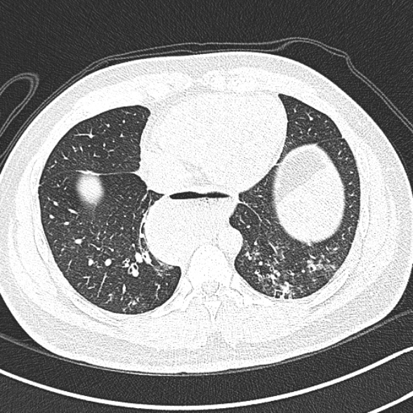 File:Achalasia with aspiration (Radiopaedia 55413-61845 Axial lung window 55).jpg