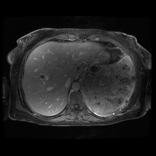 Acinar cell carcinoma of the pancreas (Radiopaedia 75442-86668 Axial T1 C+ fat sat 110).jpg