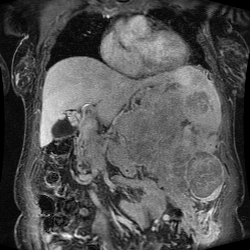 Acinar cell carcinoma of the pancreas (Radiopaedia 75442-86668 Coronal T1 C+ fat sat 123).jpg