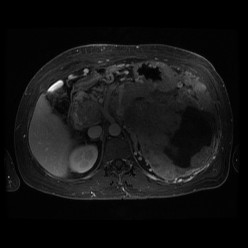 Acinar cell carcinoma of the pancreas (Radiopaedia 75442-86668 D 68).jpg