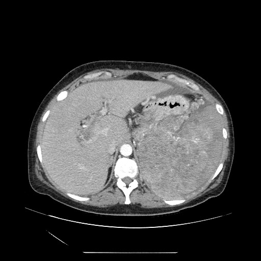 File:Acinar cell carcinoma of the pancreas (Radiopaedia 75442-86669 Axial C+ portal venous phase 30).jpg