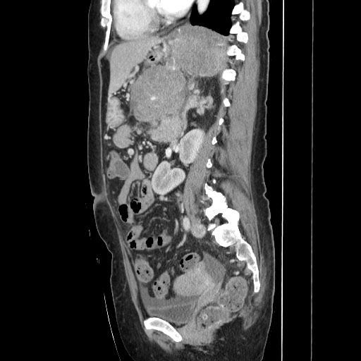 File:Acinar cell carcinoma of the pancreas (Radiopaedia 75442-86669 Sagittal C+ portal venous phase 112).jpg