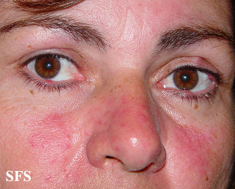 File:Acne Rosacea (Dermatology Atlas 12).jpg