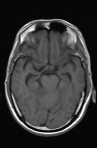 File:Acoustic schwannoma - probable (Radiopaedia 20386-20292 Axial T1 8).jpg